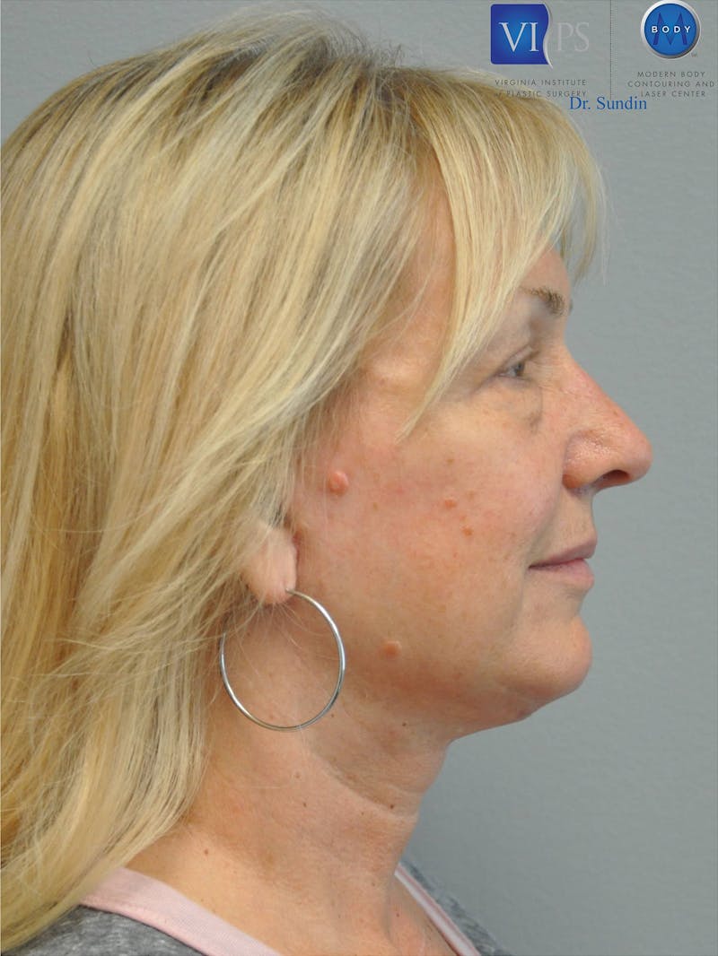 Neck Lift Before & After Gallery - Patient 201181563 - Image 4
