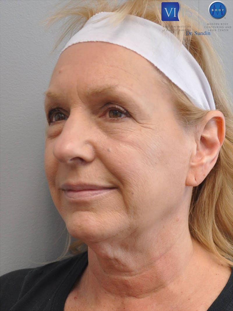 Facelift Before & After Gallery - Patient 201181556 - Image 7