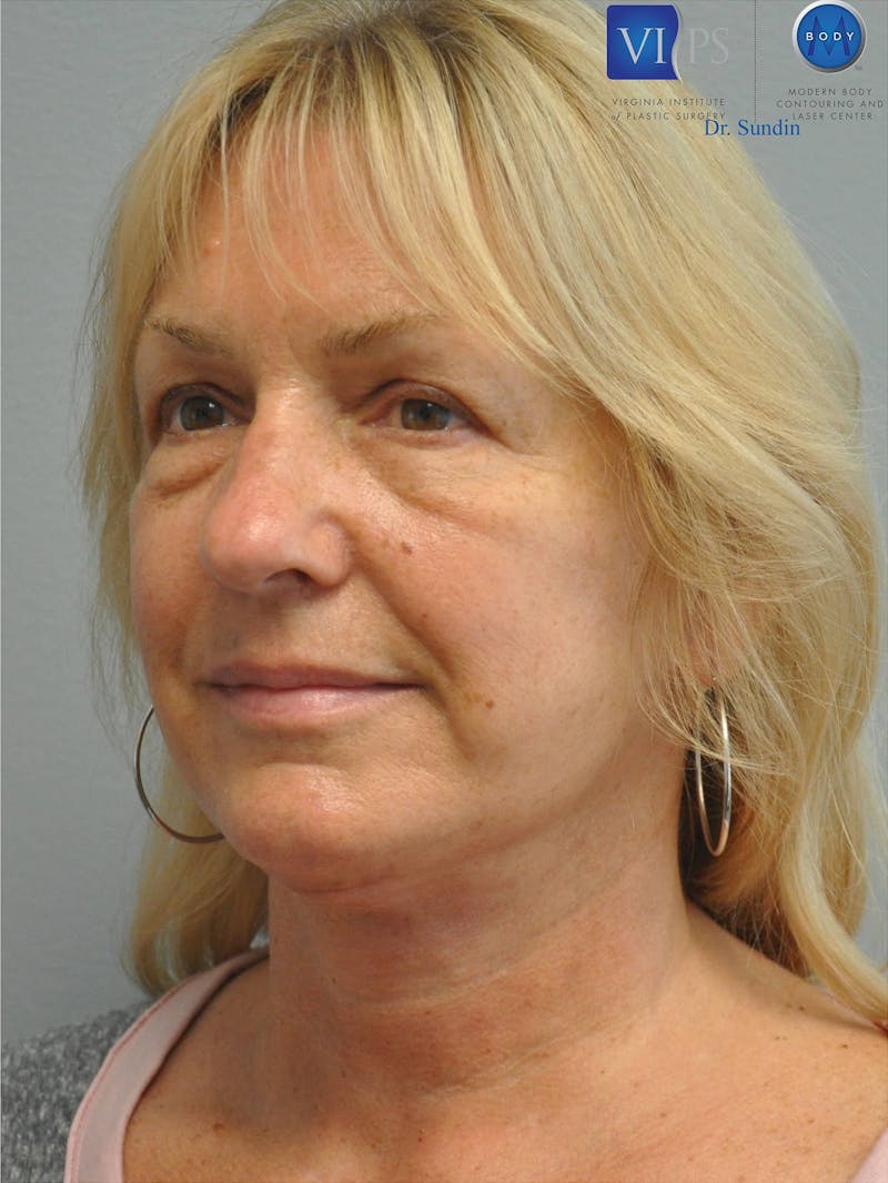 Facelift Before & After Gallery - Patient 201181556 - Image 8