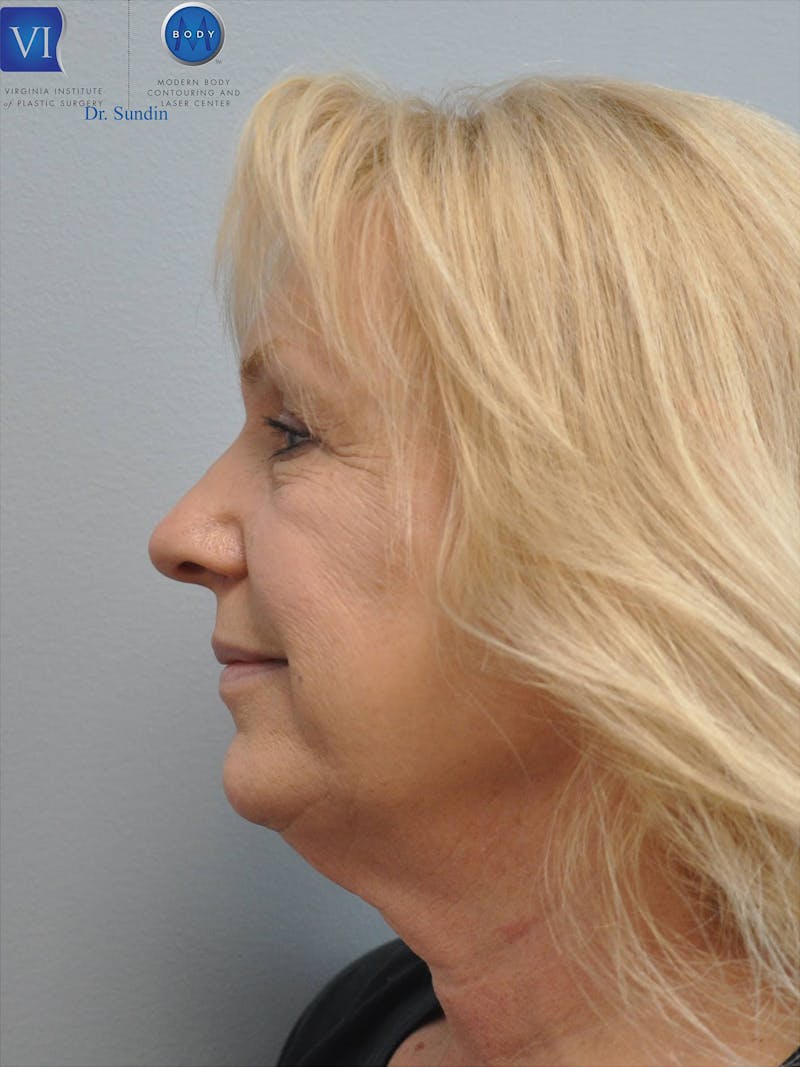Neck Lift Before & After Gallery - Patient 201181563 - Image 7