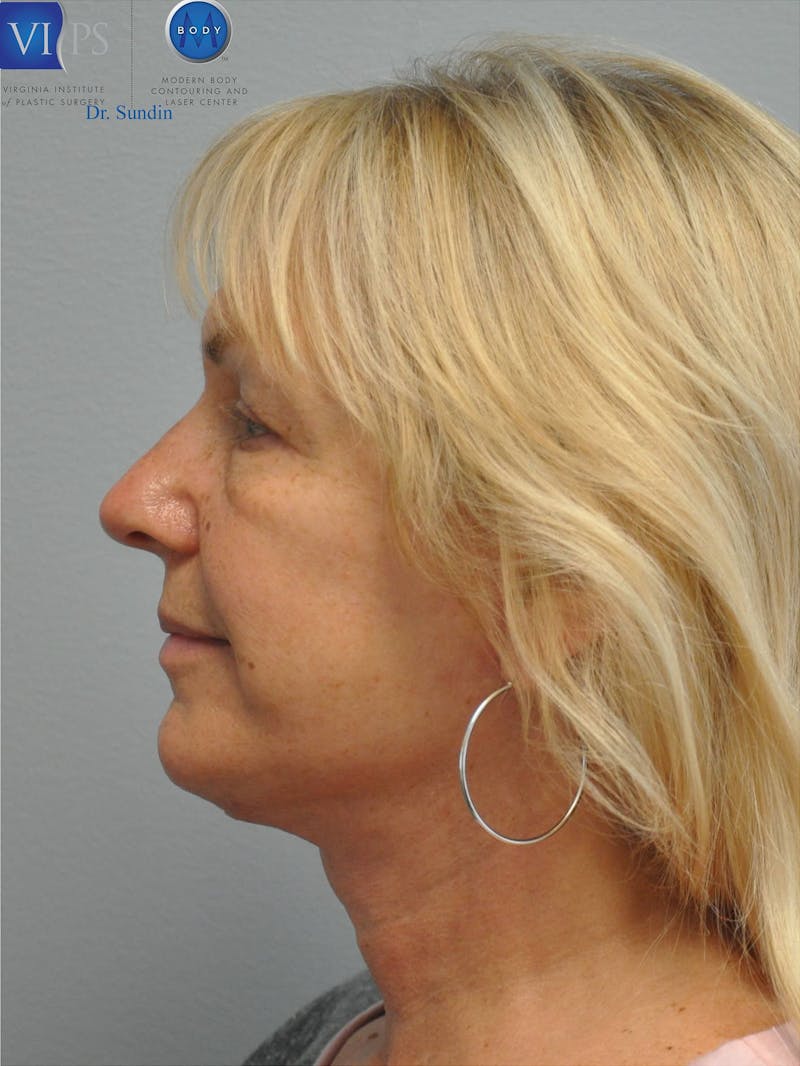 Neck Lift Before & After Gallery - Patient 201181563 - Image 8