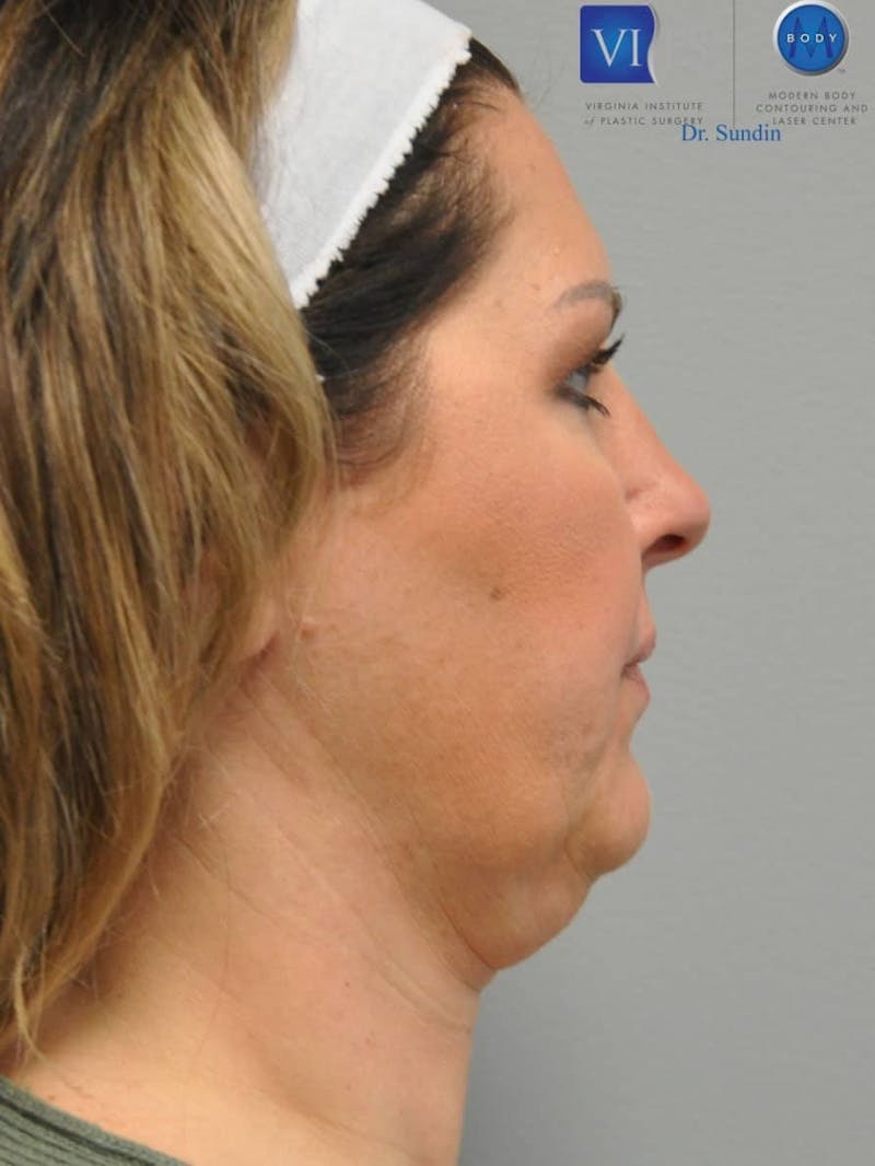 Facelift Before & After Gallery - Patient 201181555 - Image 3
