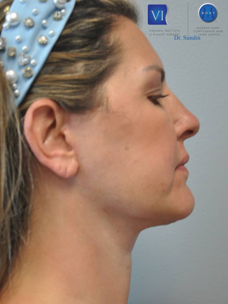 Facelift Before & After Gallery - Patient 201181555 - Image 4