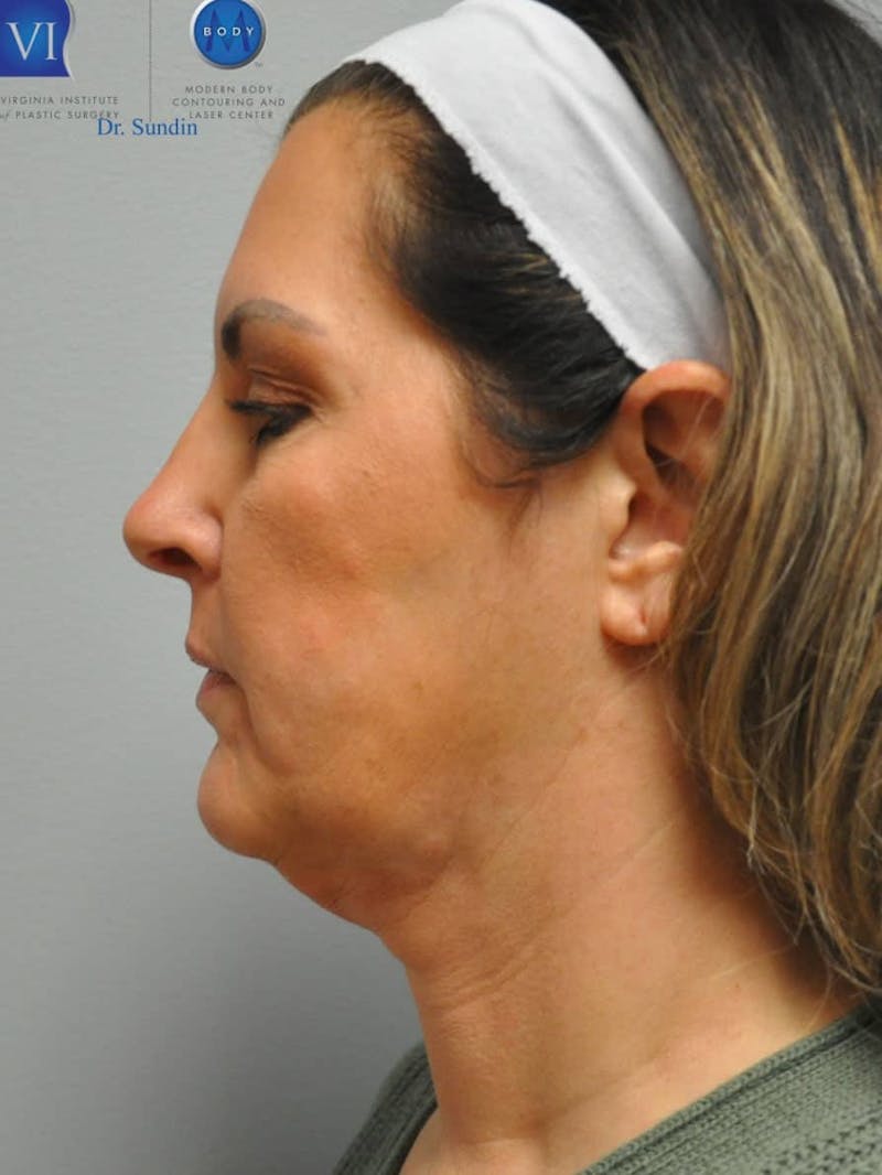 Facelift Before & After Gallery - Patient 201181555 - Image 9