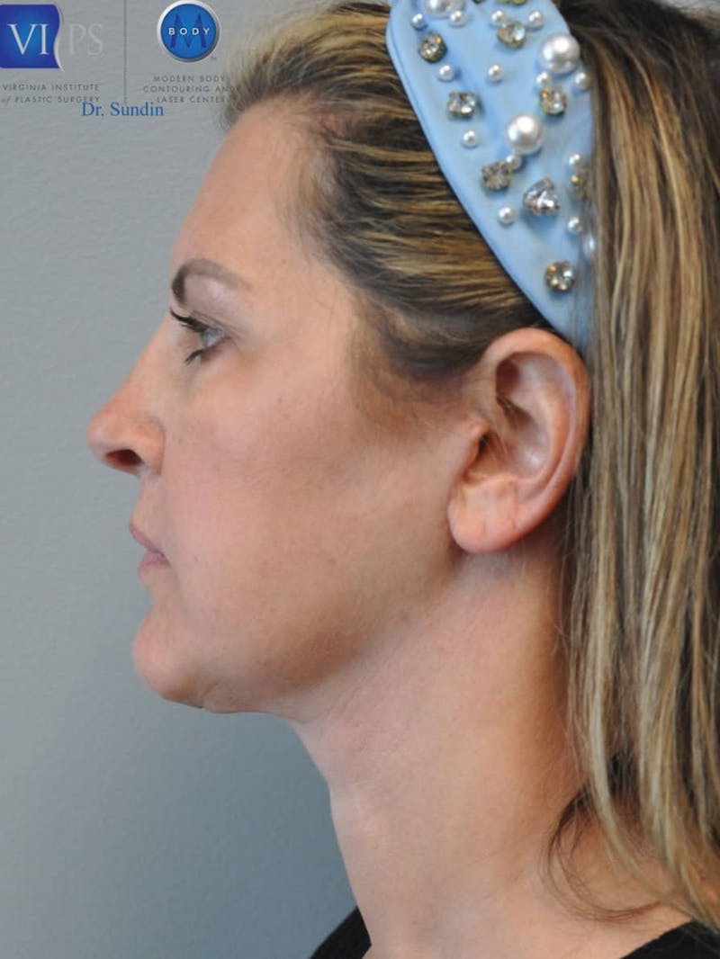 Facelift Before & After Gallery - Patient 201181555 - Image 10