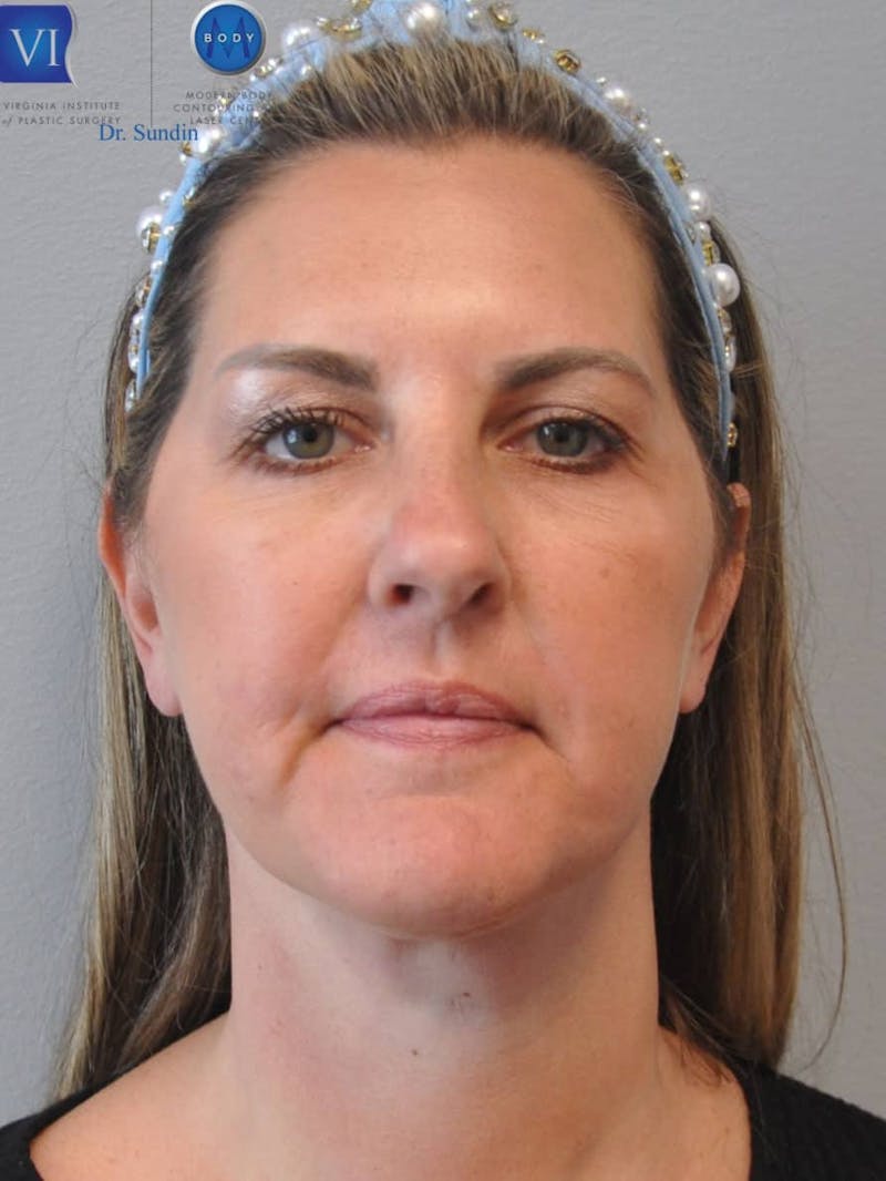 Facelift Before & After Gallery - Patient 201181555 - Image 2