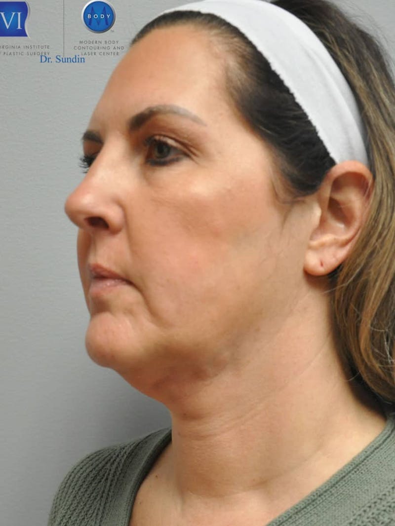 Neck Lift Before & After Gallery - Patient 201181561 - Image 7