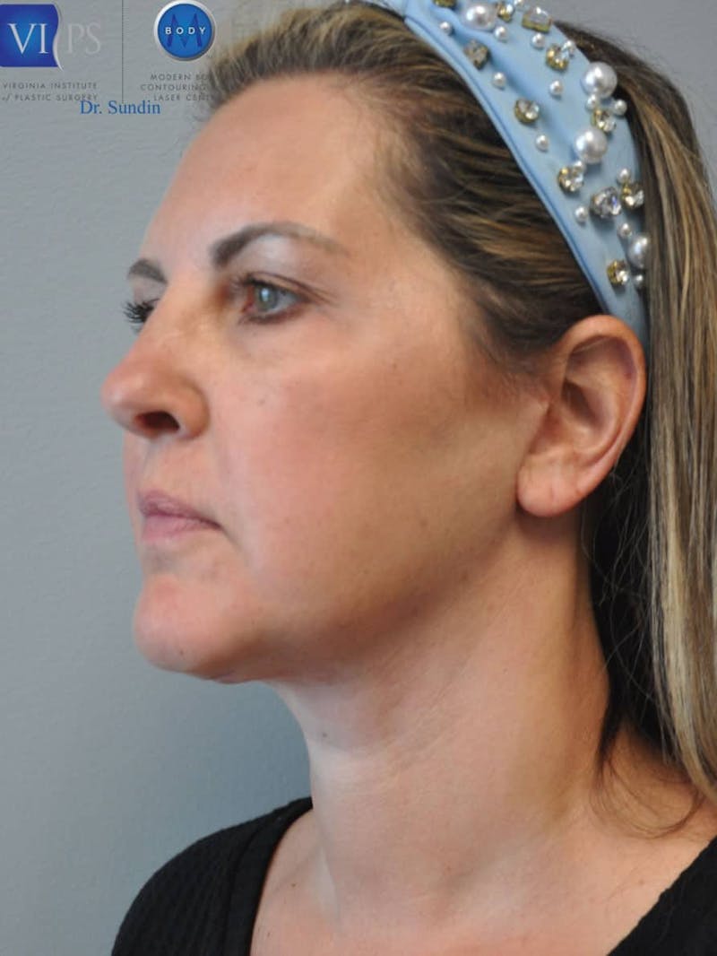 Facelift Before & After Gallery - Patient 201181555 - Image 8