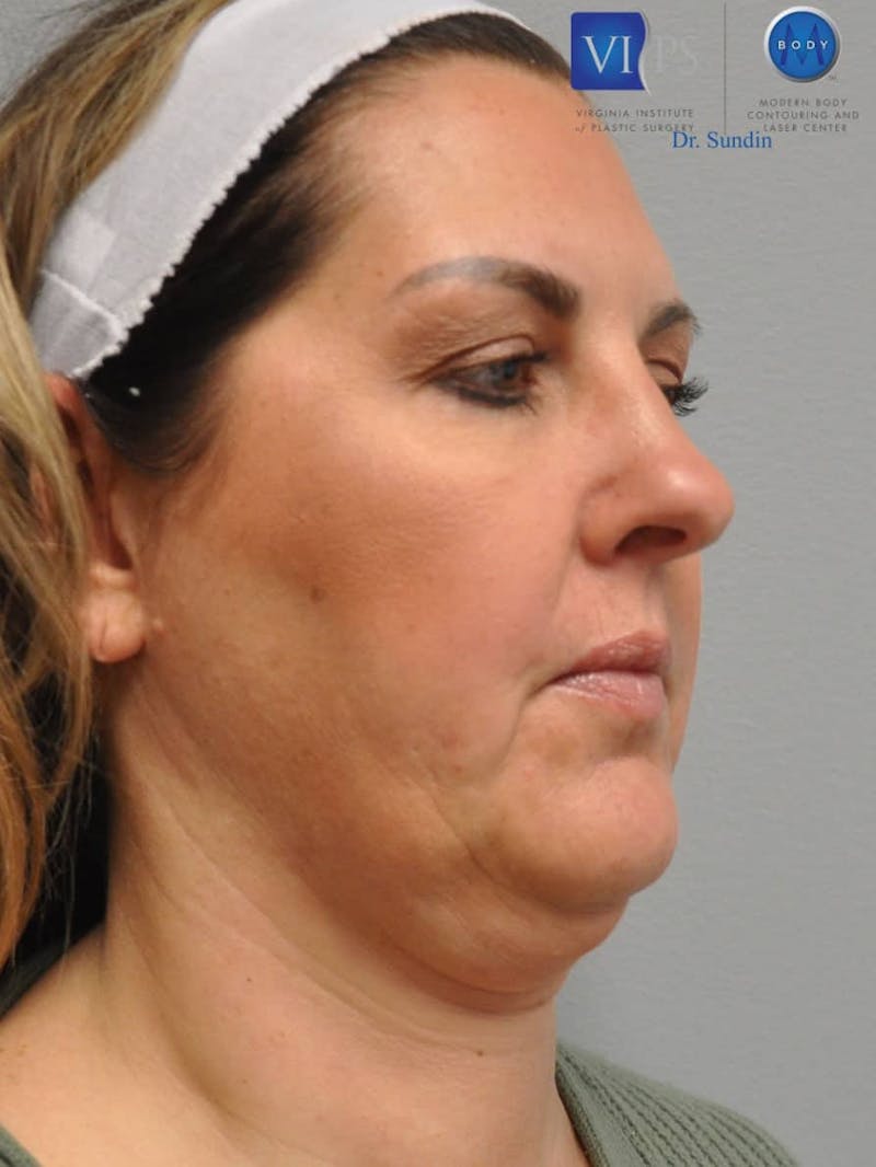 Facelift Before & After Gallery - Patient 201181555 - Image 5