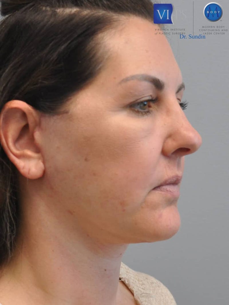 Neck Lift Before & After Gallery - Patient 201181561 - Image 2
