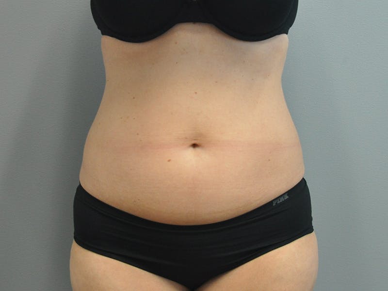 Liposuction Before & After Gallery - Patient 211876580 - Image 1