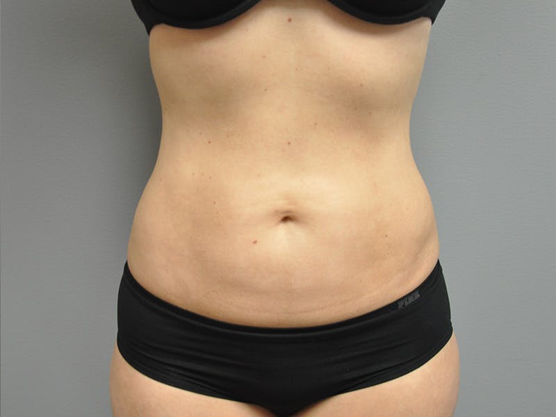 Liposuction Before & After Gallery - Patient 211876580 - Image 2