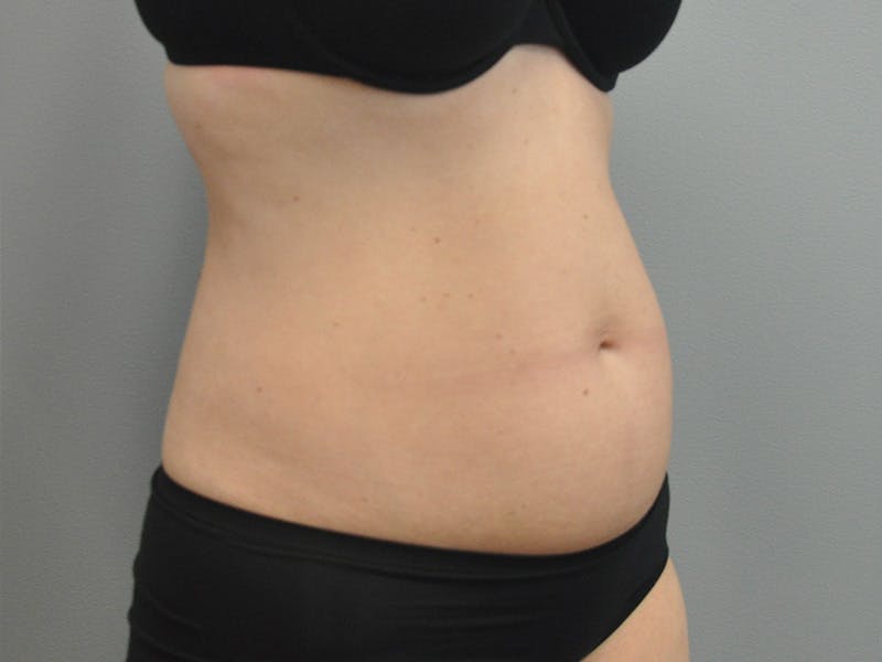 Liposuction Before & After Gallery - Patient 211876580 - Image 3