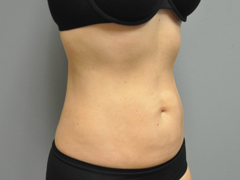Liposuction Before & After Gallery - Patient 211876580 - Image 4