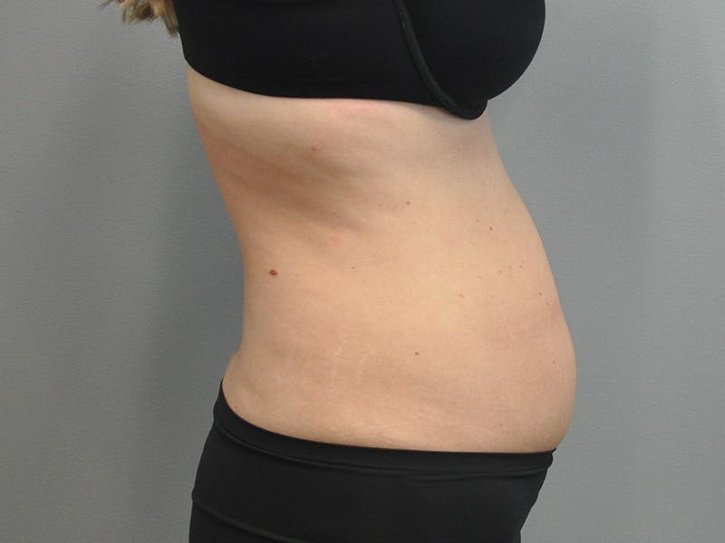 Liposuction Before & After Gallery - Patient 211876580 - Image 5