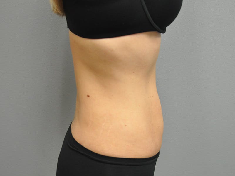 Liposuction Before & After Gallery - Patient 211876580 - Image 6
