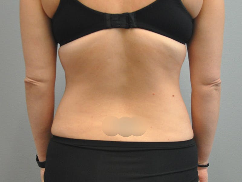 Renuvion J-Plasma Before & After Gallery - Patient 211876528 - Image 7