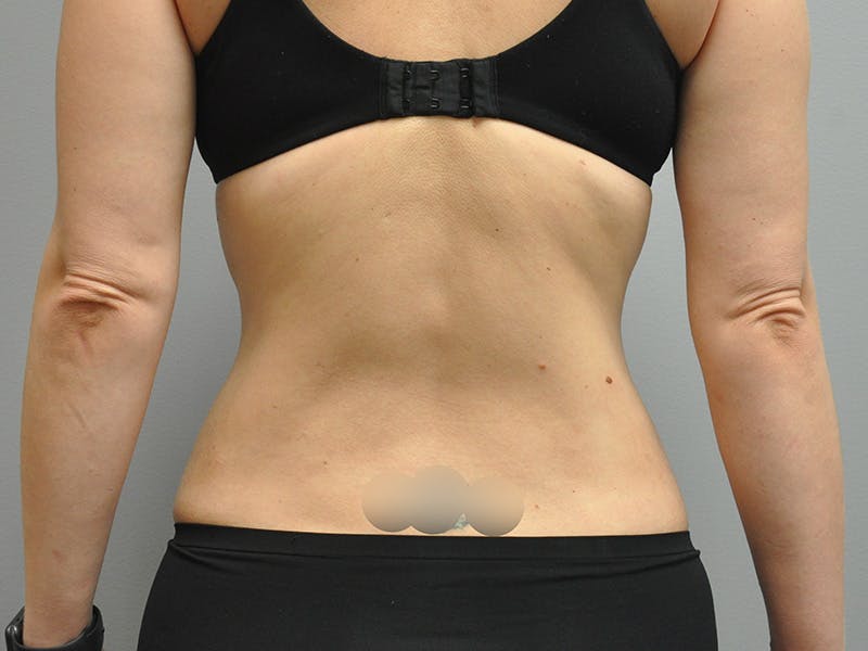 Liposuction Before & After Gallery - Patient 211876580 - Image 8