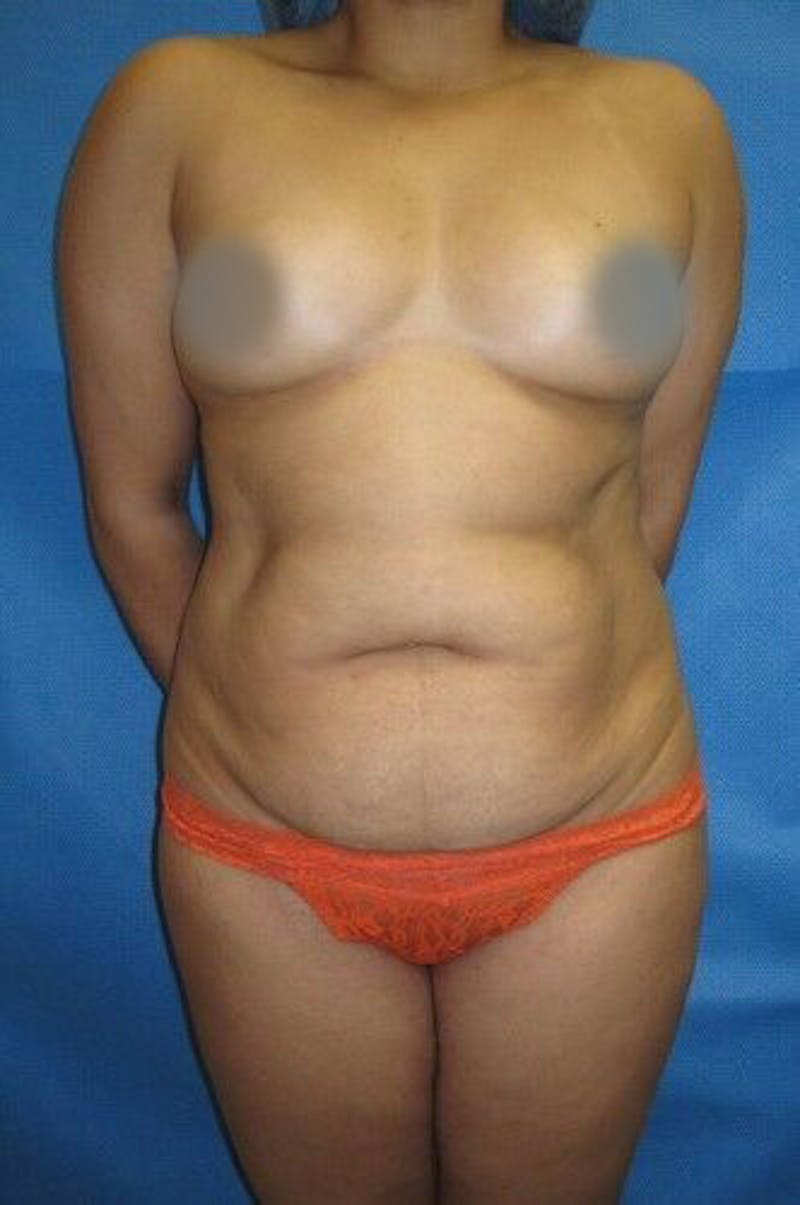 Liposuction Before & After Gallery - Patient 211876596 - Image 1