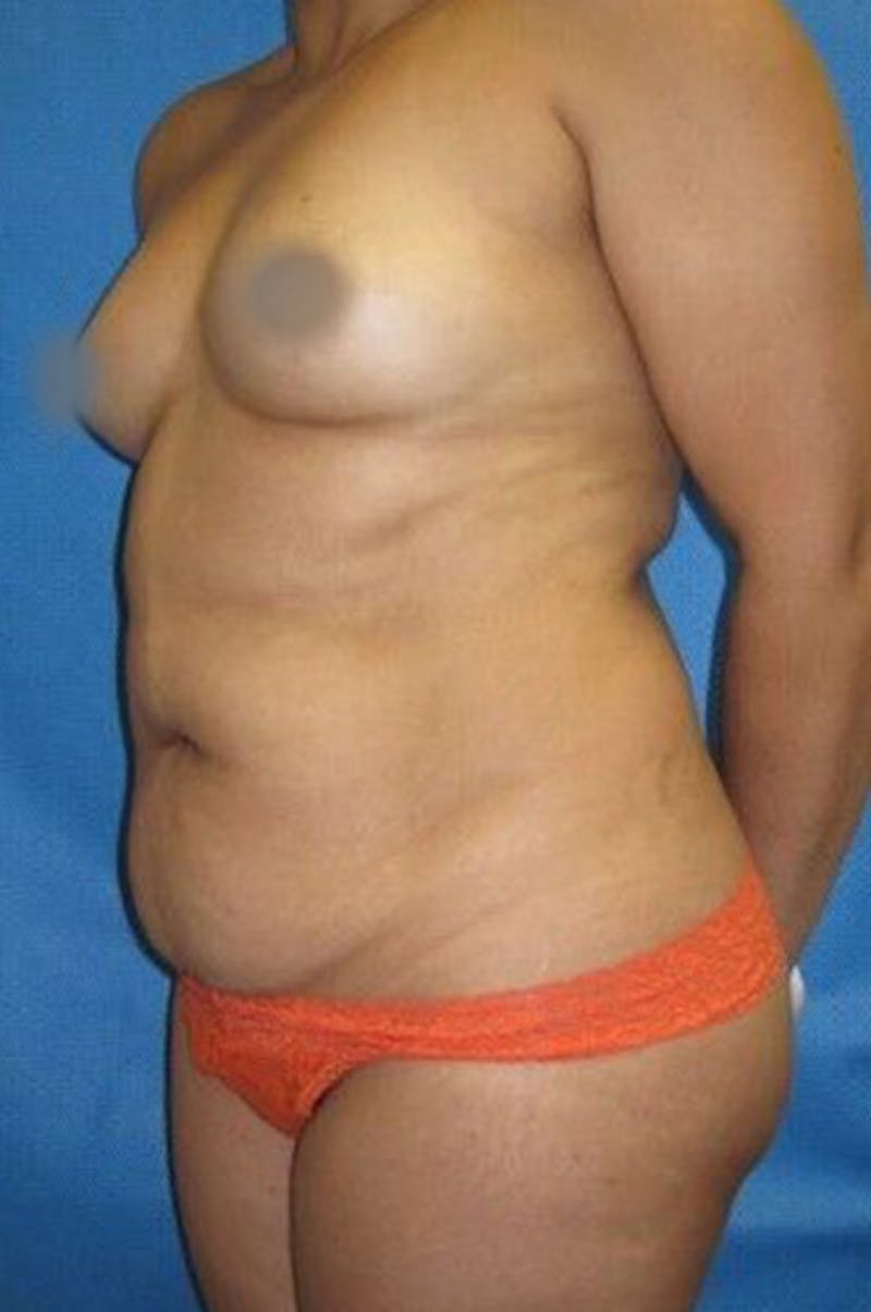 Liposuction Before & After Gallery - Patient 211876596 - Image 7
