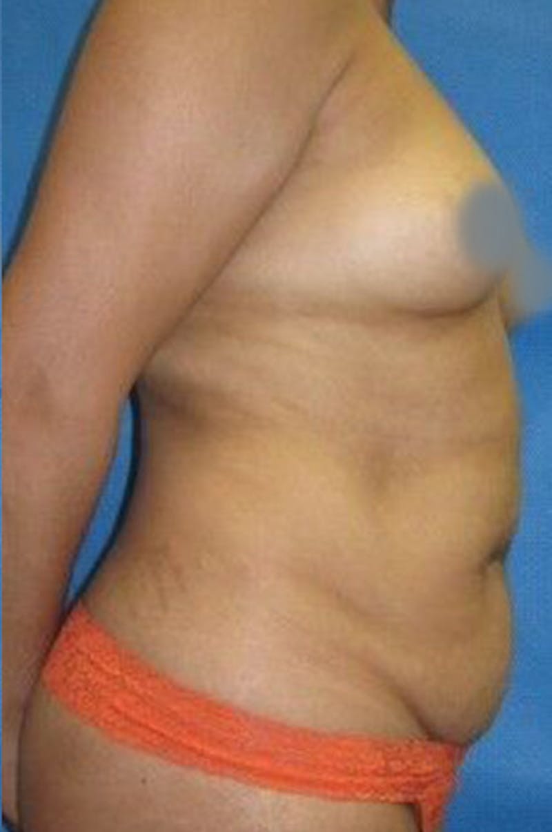 Renuvion J-Plasma Before & After Gallery - Patient 211876538 - Image 9