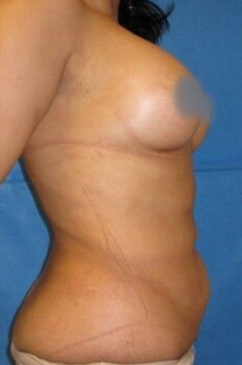 Renuvion J-Plasma Before & After Gallery - Patient 211876538 - Image 10