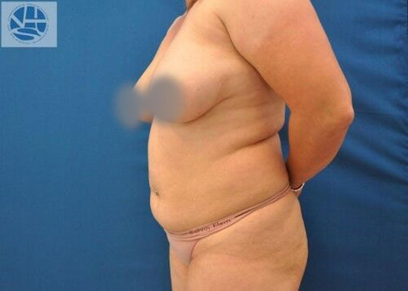 Liposuction Before & After Gallery - Patient 211876597 - Image 1