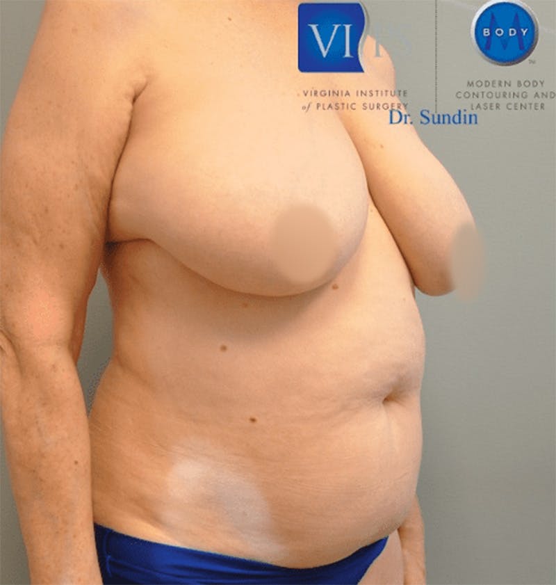 Renuvion J-Plasma Before & After Gallery - Patient 211876543 - Image 1