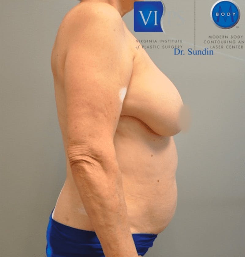 Renuvion J-Plasma Before & After Gallery - Patient 211876543 - Image 3