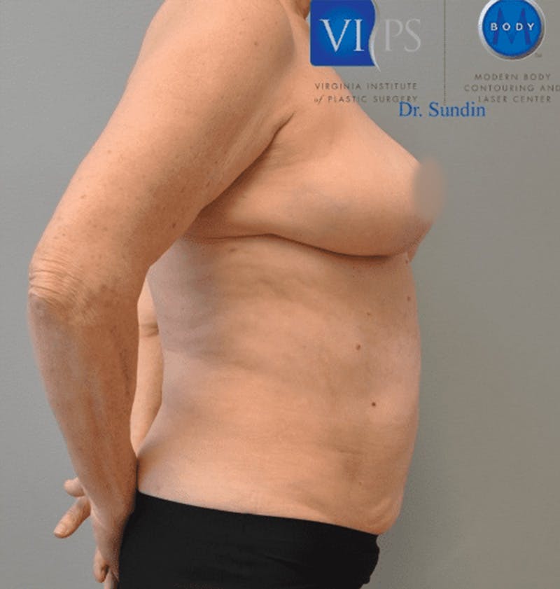 Renuvion J-Plasma Before & After Gallery - Patient 211876543 - Image 4