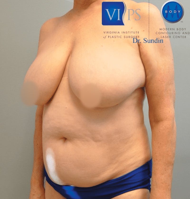 Liposuction Before & After Gallery - Patient 211876598 - Image 5