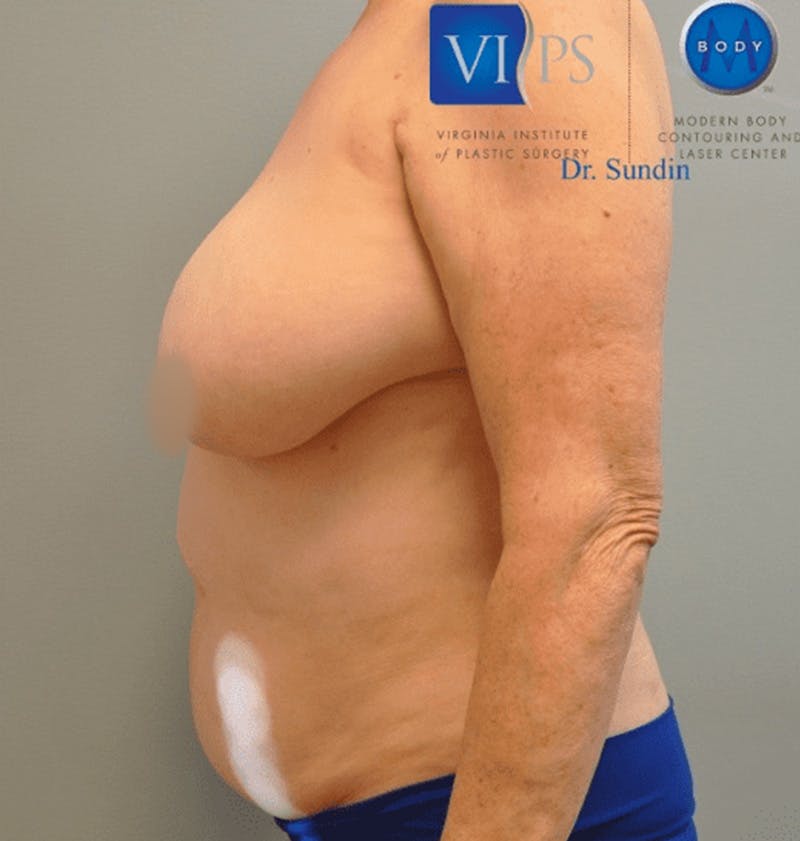 Liposuction Before & After Gallery - Patient 211876598 - Image 7