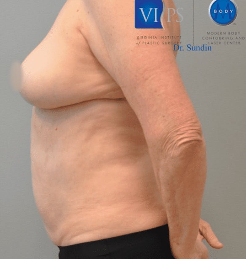 Liposuction Before & After Gallery - Patient 211876598 - Image 8