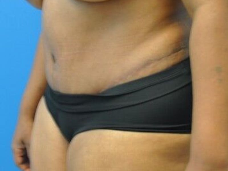 Tummy Tuck Before & After Gallery - Patient 55345357 - Image 6