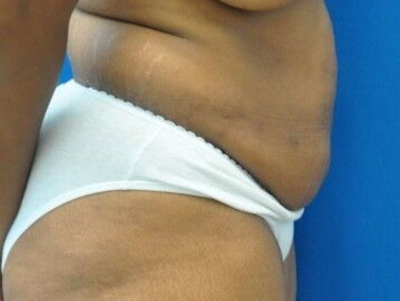Tummy Tuck Before & After Gallery - Patient 55345357 - Image 7