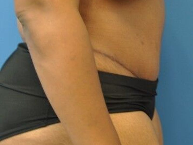 Tummy Tuck Before & After Gallery - Patient 55345357 - Image 8