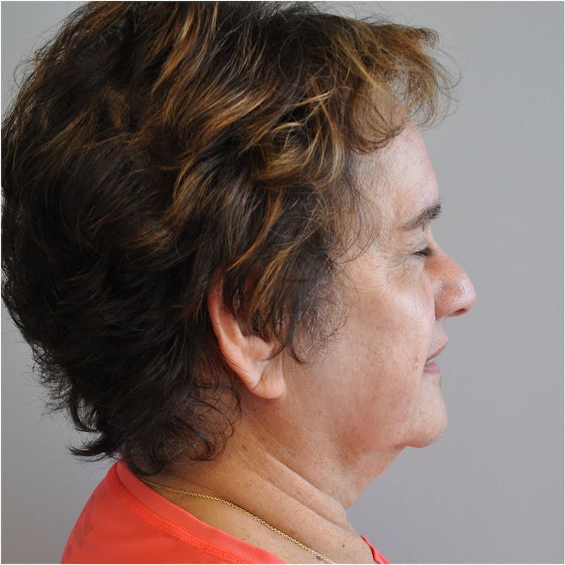 Facelift Before & After Gallery - Patient 115073 - Image 5