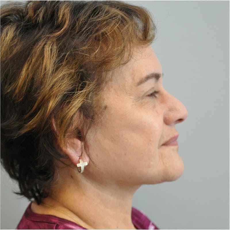 Neck Lift Before & After Gallery - Patient 304762 - Image 2