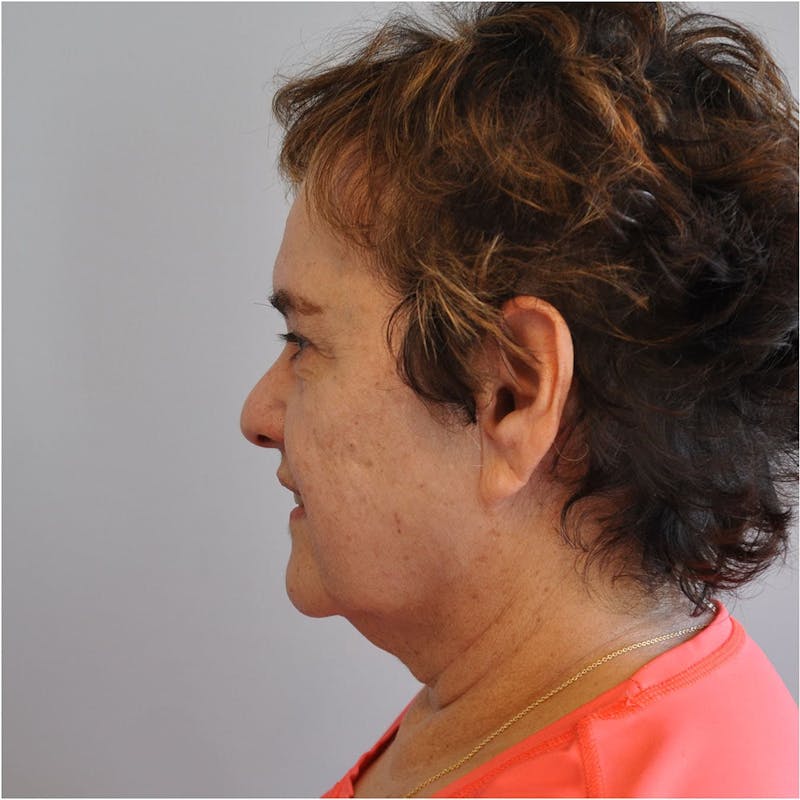 Facelift Before & After Gallery - Patient 115073 - Image 7