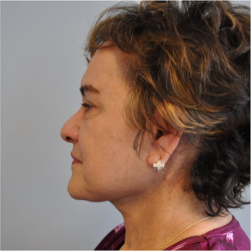 Facelift Before & After Gallery - Patient 115073 - Image 8