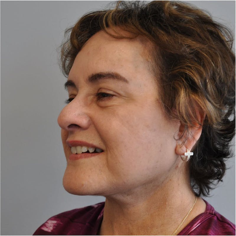 Facelift Before & After Gallery - Patient 115073 - Image 10