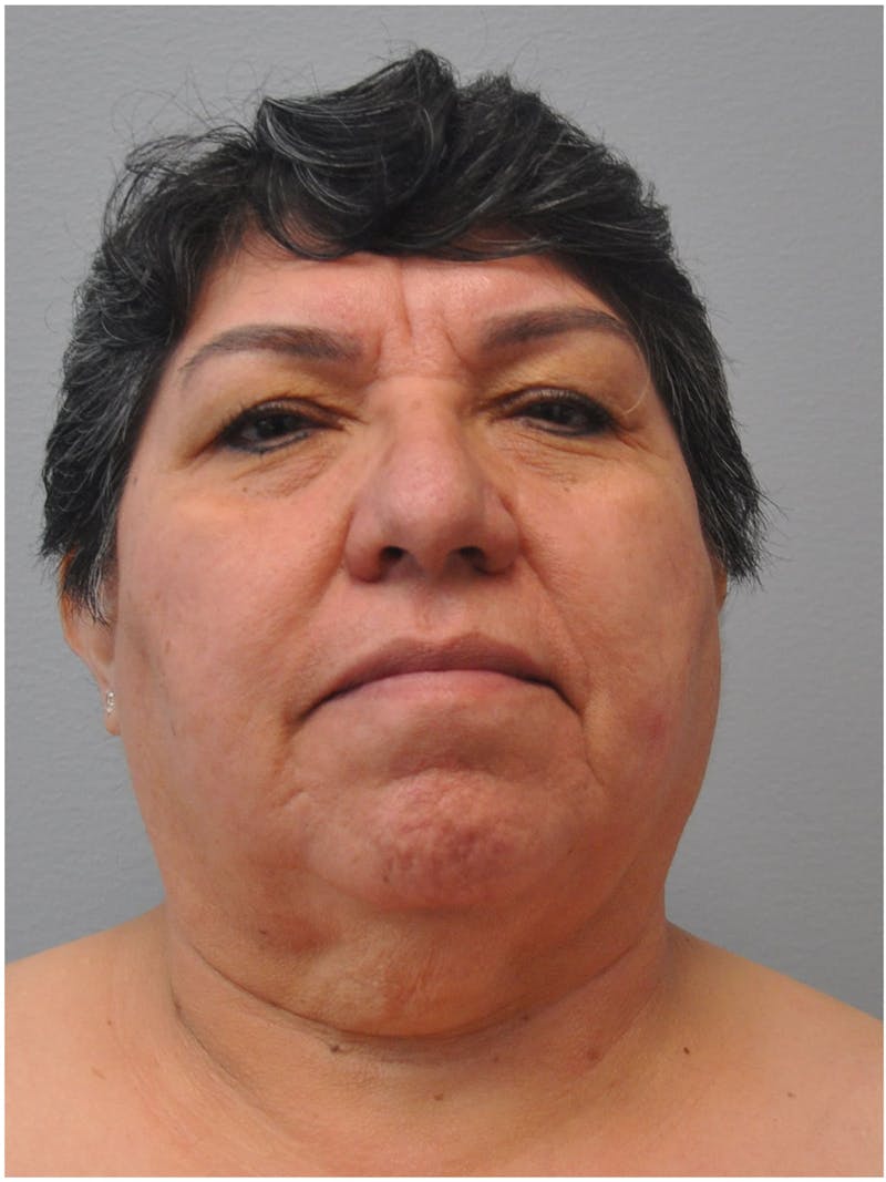 Facelift Before & After Gallery - Patient 241921 - Image 1