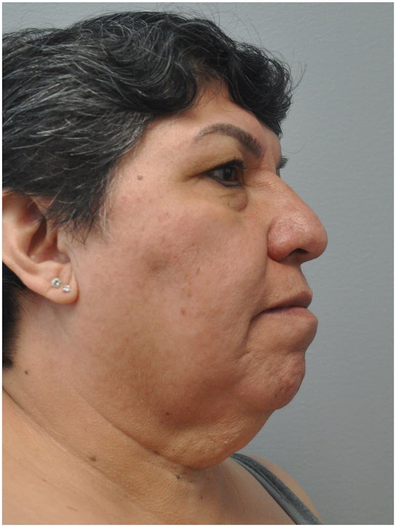 Facelift Before & After Gallery - Patient 241921 - Image 3