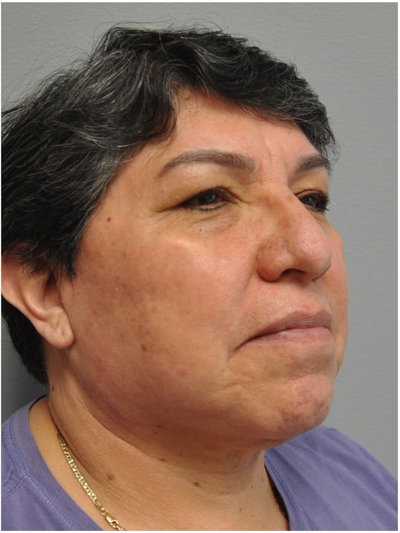 Facelift Before & After Gallery - Patient 241921 - Image 4