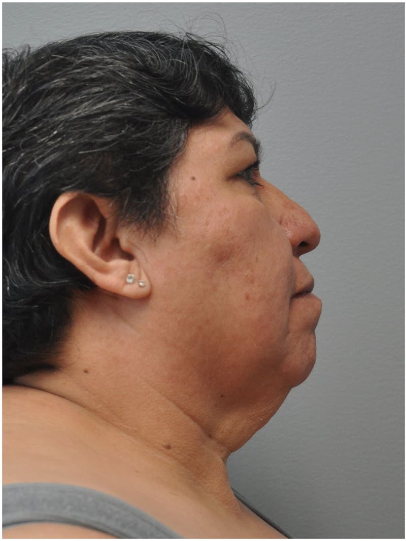 Neck Lift Before & After Gallery - Patient 257726 - Image 1