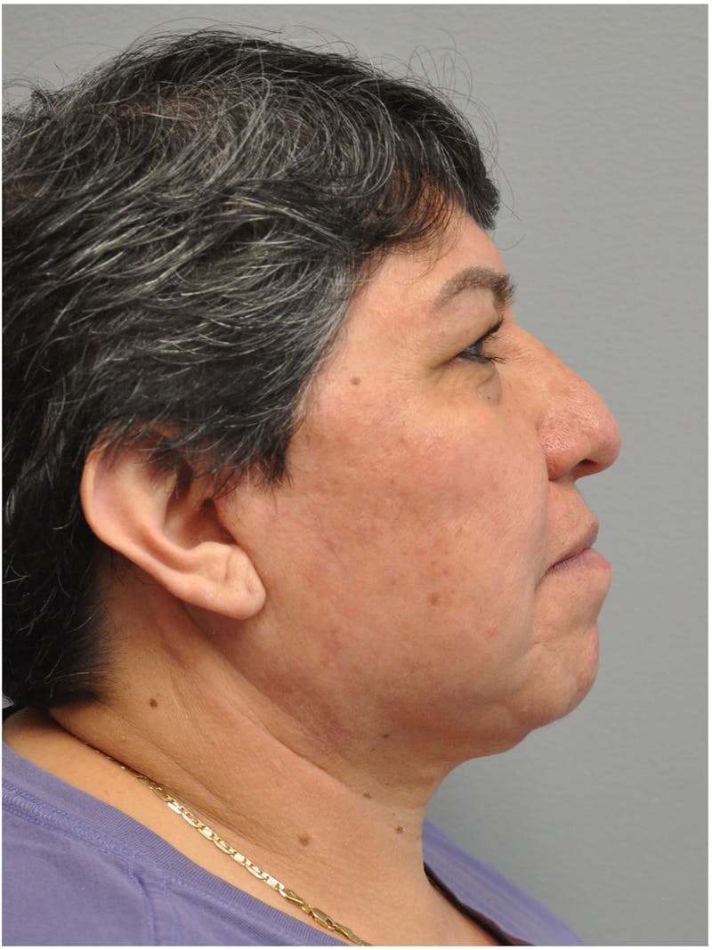Neck Lift Before & After Gallery - Patient 257726 - Image 2