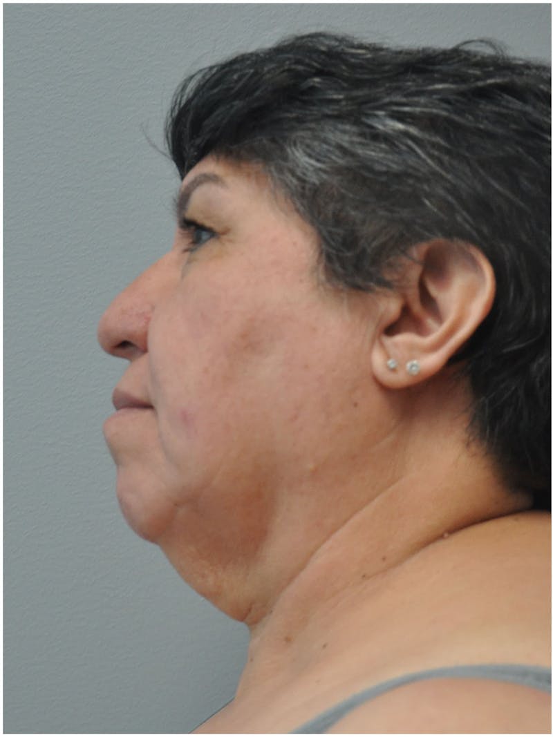 Facelift Before & After Gallery - Patient 241921 - Image 7
