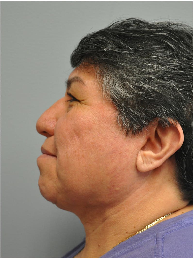 Neck Lift Before & After Gallery - Patient 257726 - Image 8