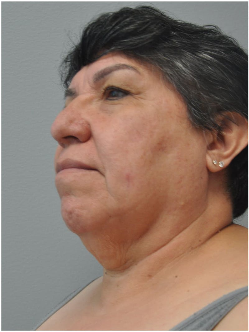 Facelift Before & After Gallery - Patient 241921 - Image 9