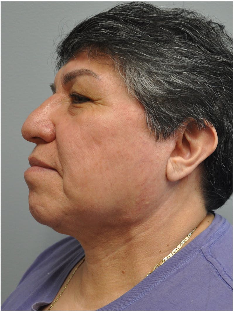 Neck Lift Before & After Gallery - Patient 257726 - Image 10